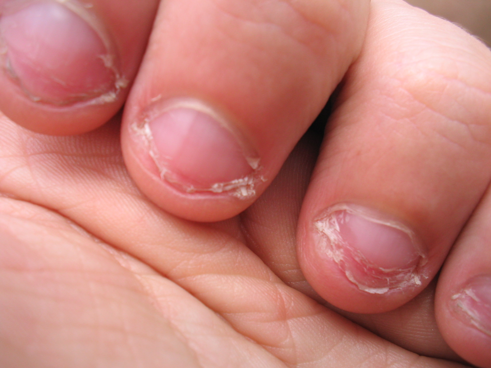 Nagelbeißer Nagelbeißer - Therapie